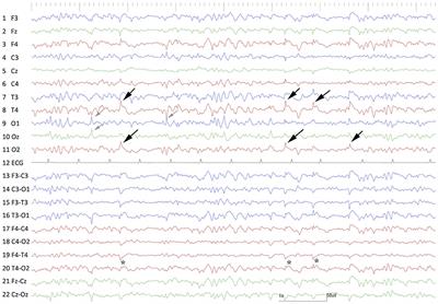 Focal Cortical Resection and Hippocampectomy in a Cat With Drug-Resistant Structural Epilepsy